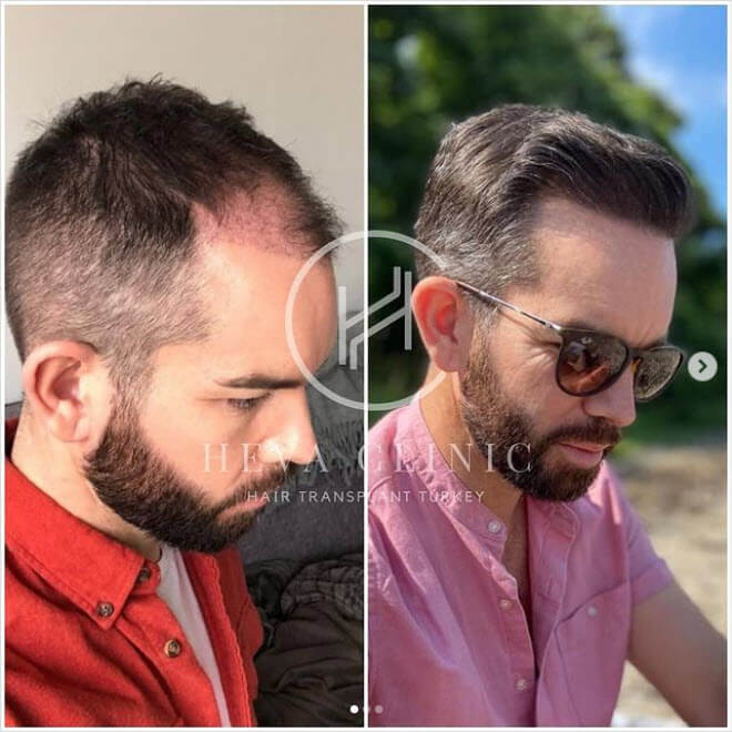 prima dopo il paziente della clinica heva instagram