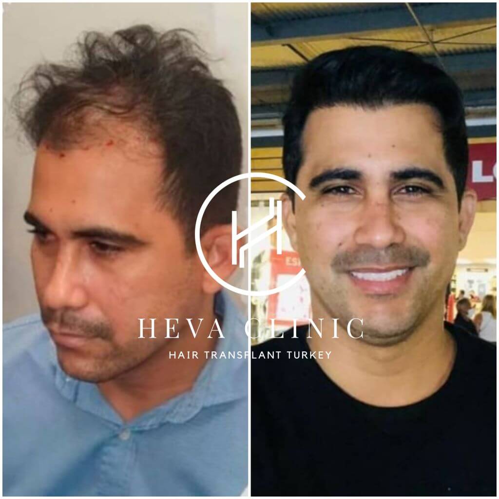 4010 innesti - Trapianto di capelli in Turchia Trapianto di capelli in Turchia - prima e dopo - 4100 innesti uomo