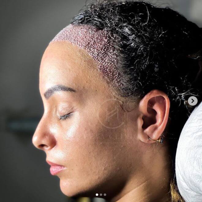 trapianto di capelli femminili dopo l'intervento chirurgico presso la clinica heva