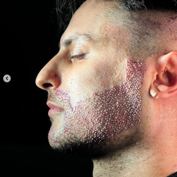 Foto paziente post operatorio trapianto di barba