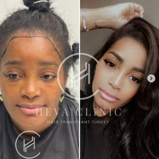 Heva Clinic per trapianto di capelli afro femminili in Turchia