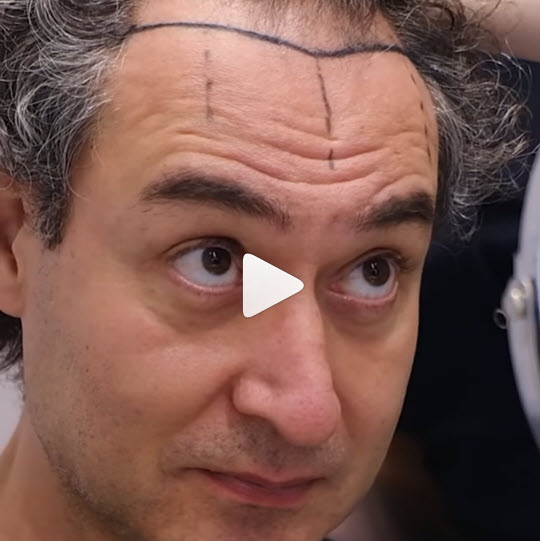Video dell'operazione di innesto di capelli 4932 presso la clinica Heva