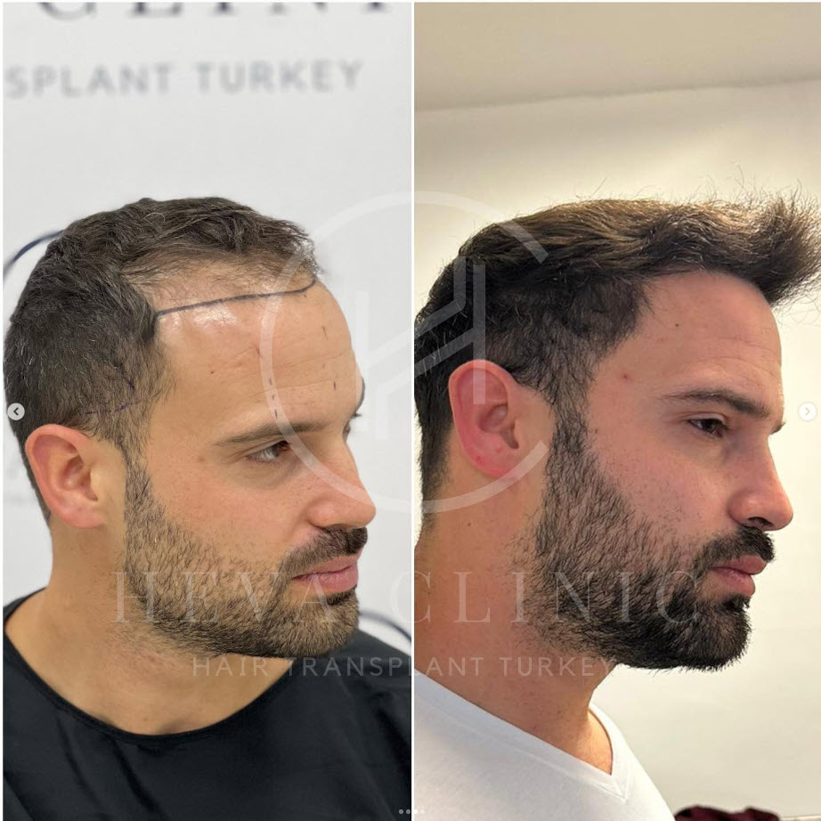 norwood-3 risultato del trapianto di capelli 3000 innesti