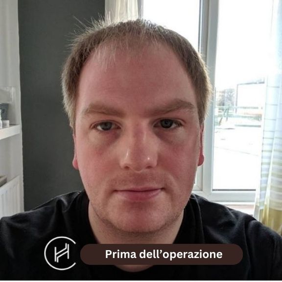 Prima-dell’operazione - trapianto di capelli