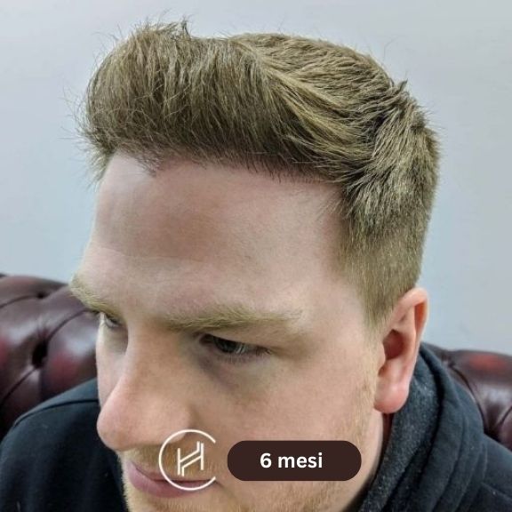 Sei mesi dopo l intervento di trapianto di capelli vista frontale