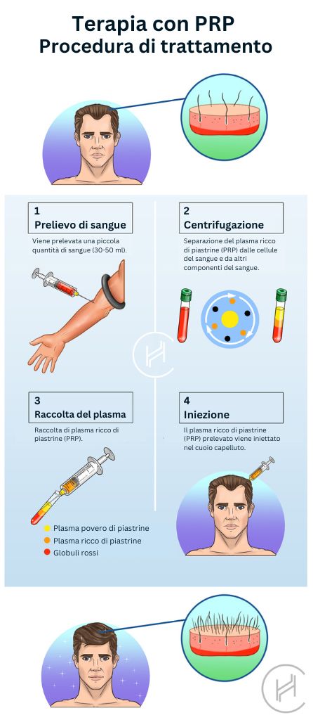 Terapia-con-PRP-procedura-di-trattamento