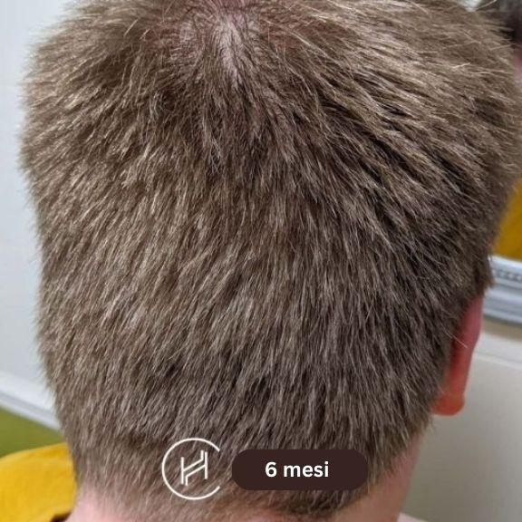 Trapianto capelli risultati dopo 6 mesi vista posteriore
