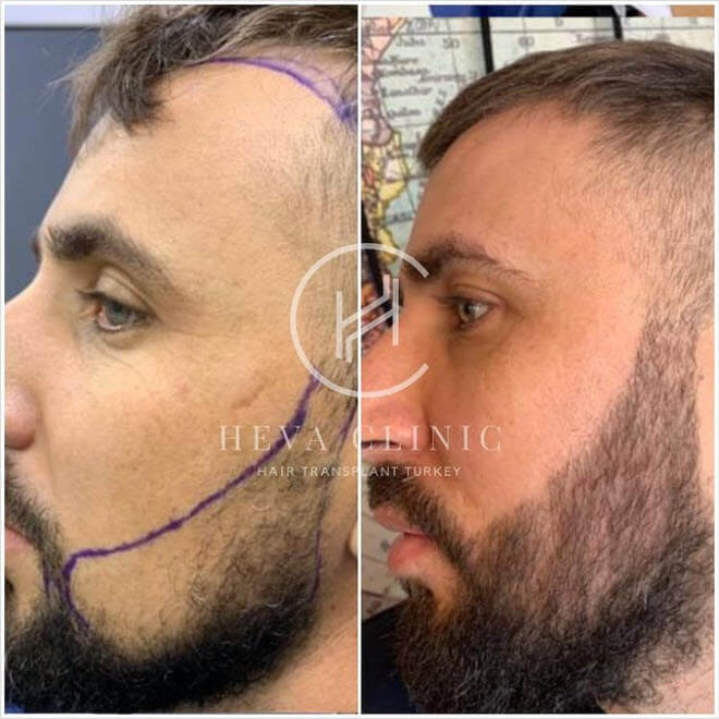 Trapianto di barba in Turchia prima e dopo