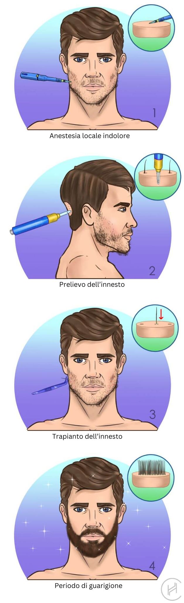 Trapianto-di-barba-quattro-fasi