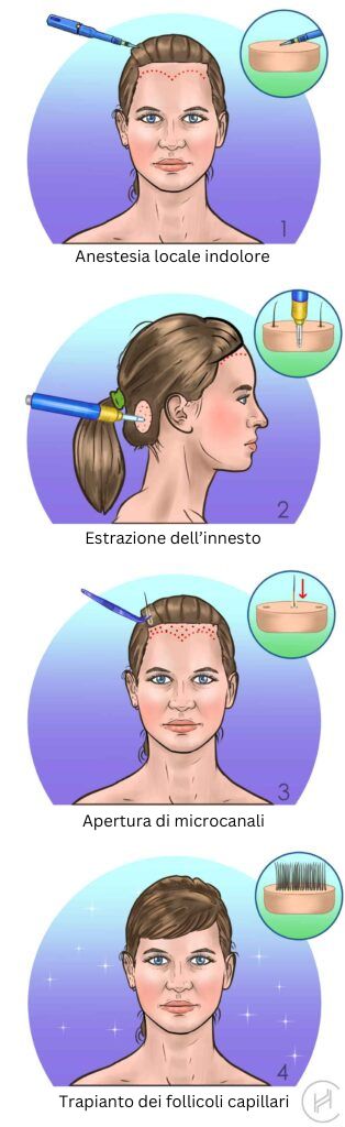 Trapianto-di-capelli-FUE-per-donne-quattro-fasi