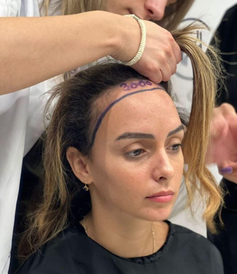 Trapianto-di-capelli-per-donne-in-Turchia