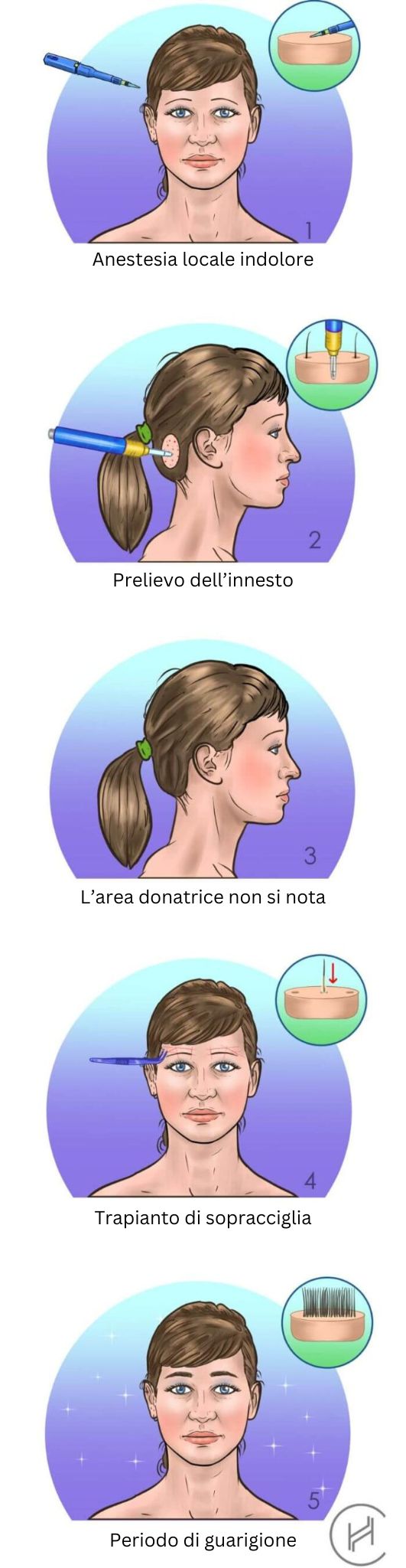 Trapiantodi sopracciglia cinque fasi