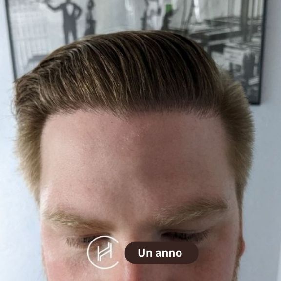 Unanno dopo l intervento di trapianto di capelli vista frontale