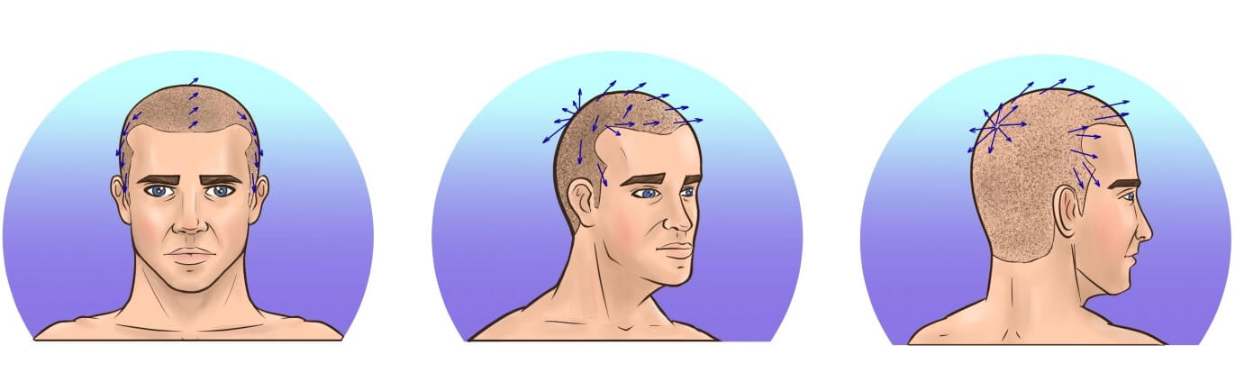 angolazione corretta del trapianto di capelli