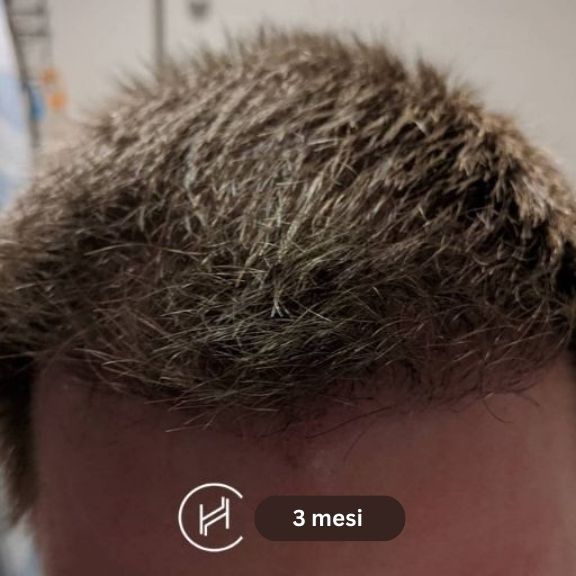 dopo il trapianto di capelli 3 mesi