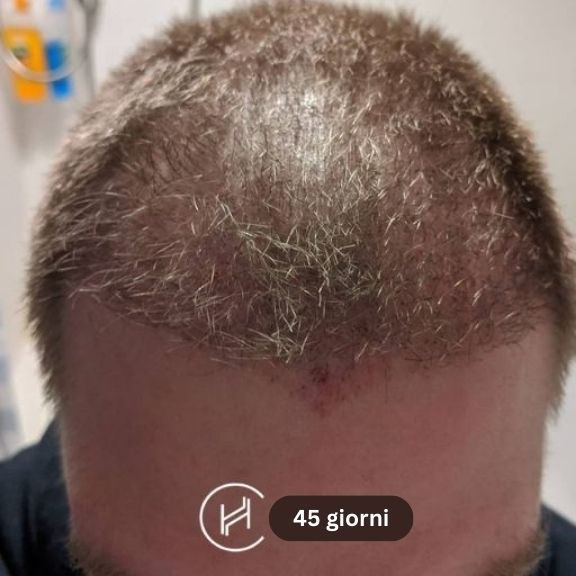 dopo il trapianto di capelli 45 giorni
