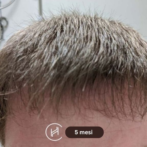 dopo il trapianto di capelli 5 mesi