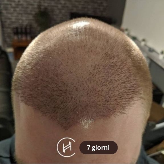 dopo il trapianto di capelli 7 giorni