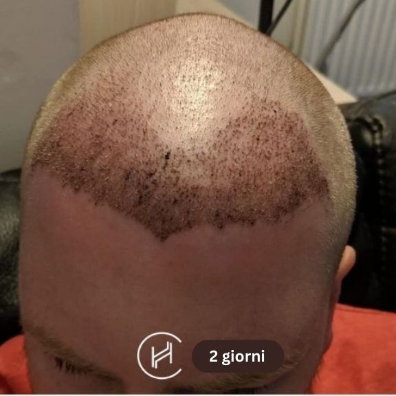 dopo-il-trapianto-di-capelli-due-giorni