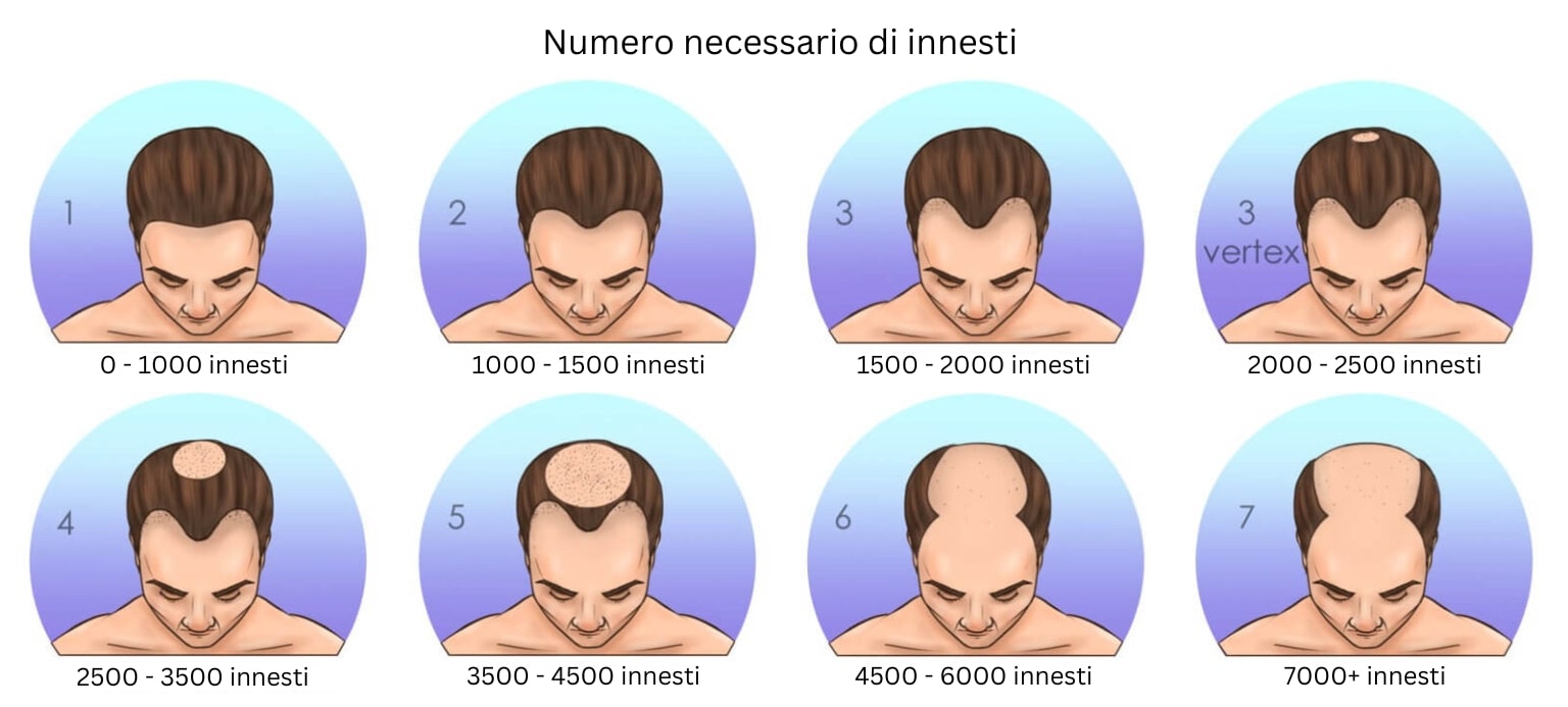 numero necessario di innestila scala di norwood
