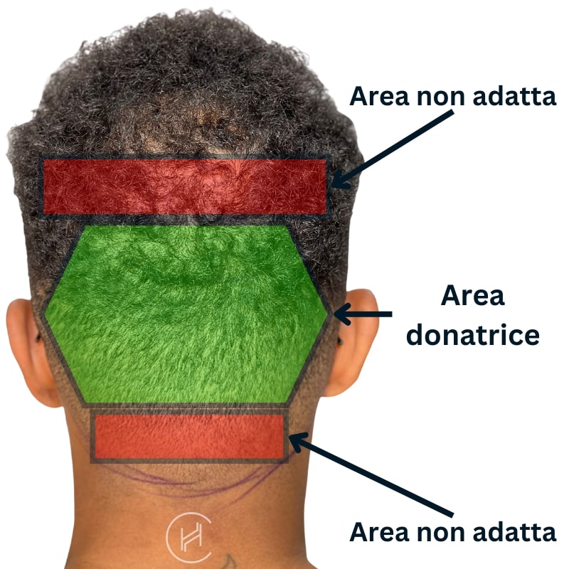 immagine dimostrativa del trapianto di capelli area donatrice