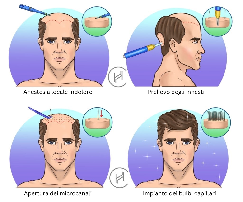 processo di trapianto di capelli