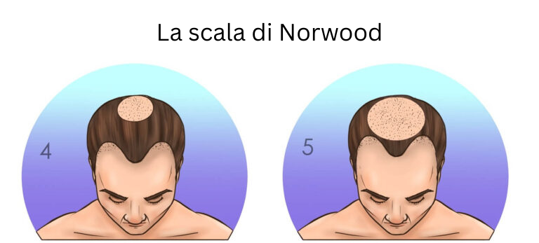 scala della calvizie di norwood stadi 4 e 5