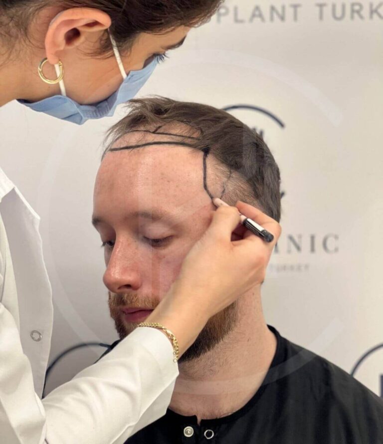 trapianto di capelli in turchia prima della procedura foto