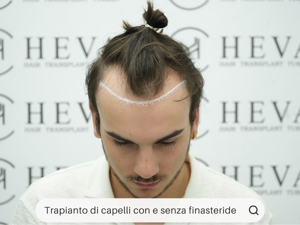 Trapianto di capelli con e senza finasteride