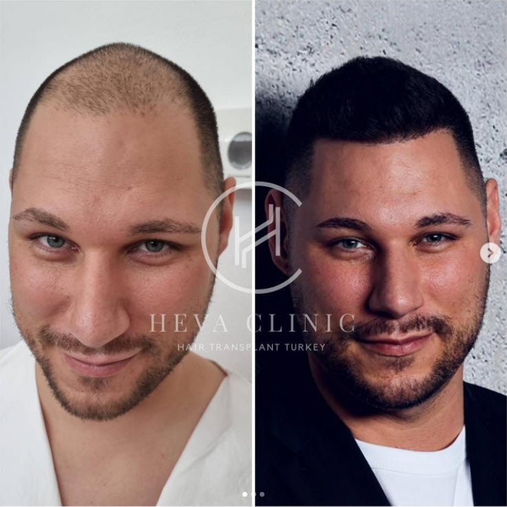 trapianto capelli 4500 innesti turchia risultato heva clinic