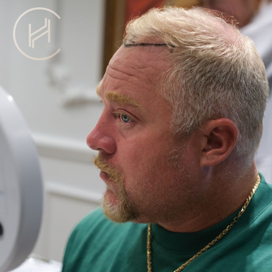 trapianto-capelli-fue-in-turchia-heva-clinic-pre-consulenza trapianto capelli fue in turchia heva clinic pre consulenza
