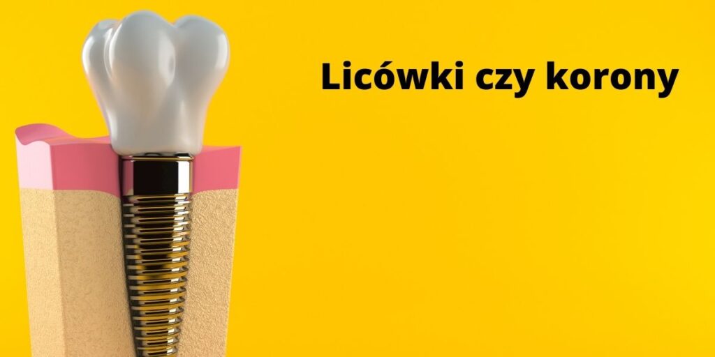 Licówki czy korony