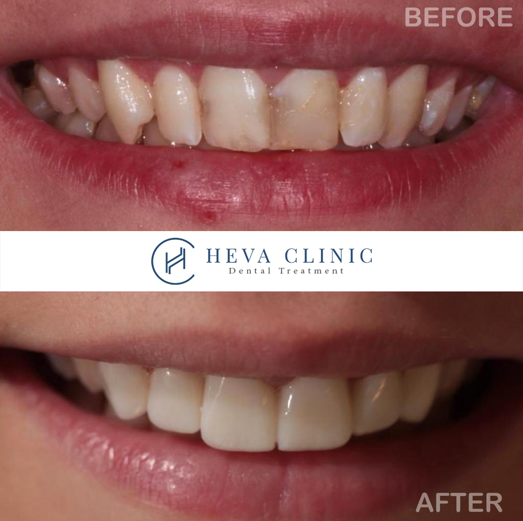 dental veneer patient before after heva clinic