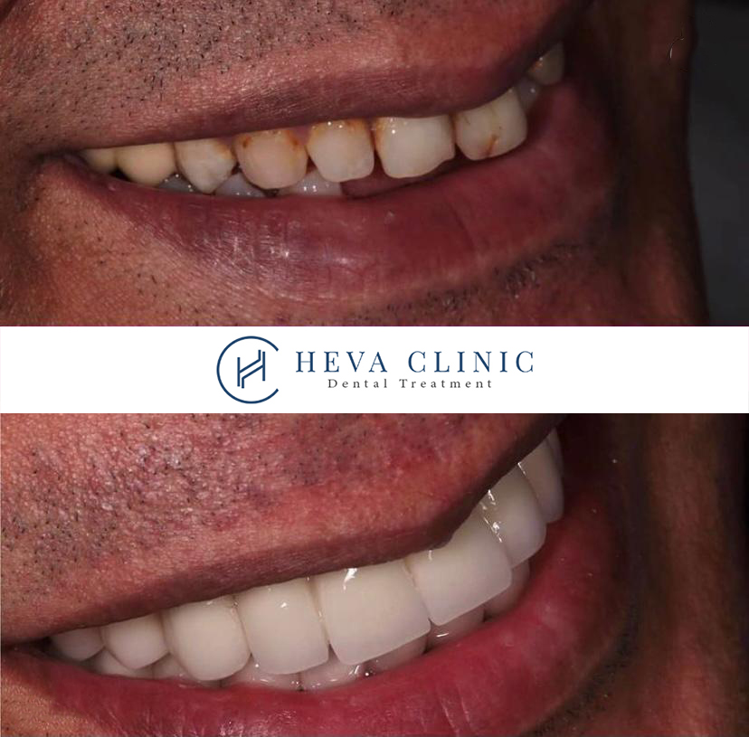 male dental veneer before after patient of heva clinic