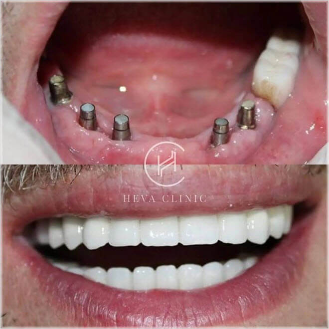 5 implantów stomatologicznych pacjent stomatologiczny