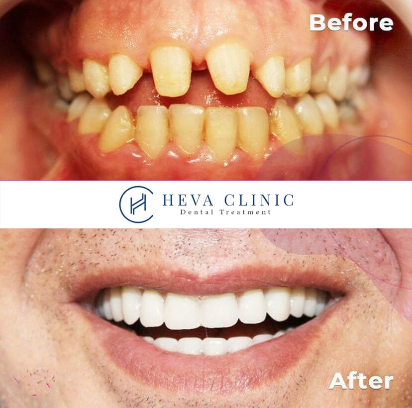 stomatologiczny hollywoodzki uśmiech pacjent przed po klinice Heva