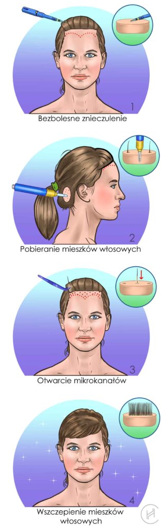 Procedura Przeszczep Włosów u Kobiet