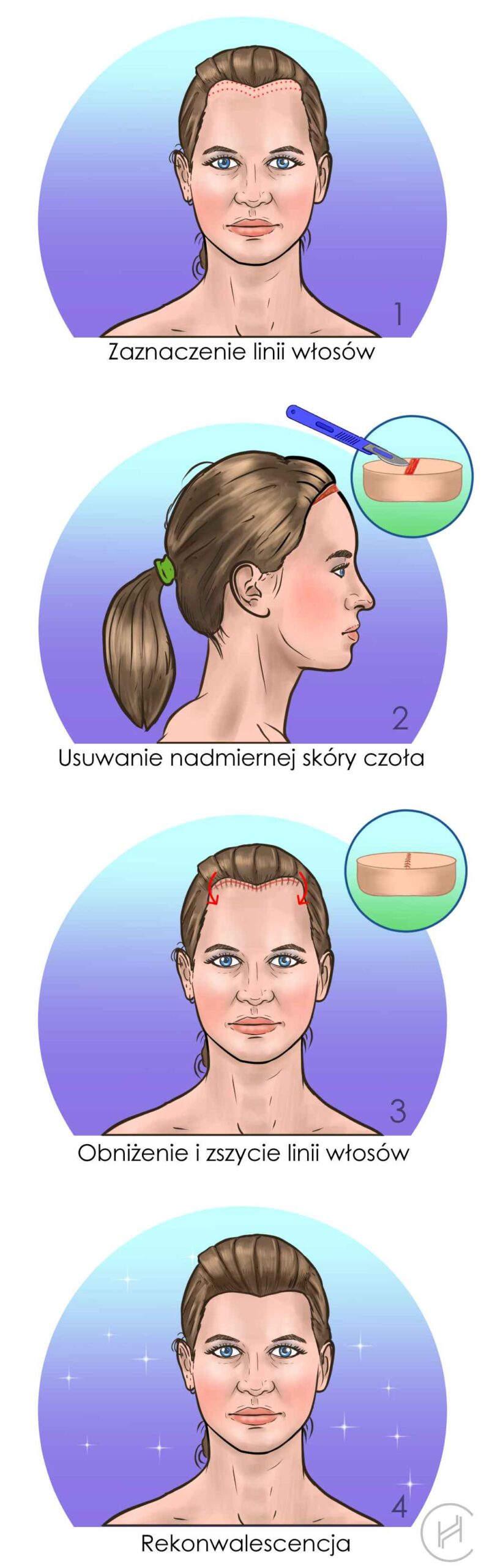 procedura obniżenie linii włosówczoła procedura obniżenie linii włosówczoła