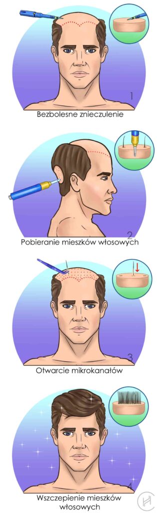 procedura przeszczepu włosów