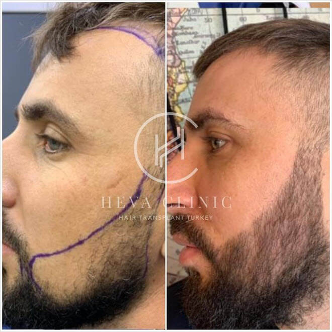Mężczyzna z rzadkim zarostem i piękną brodą po zabiegu transplantacji w Heva Clinic 