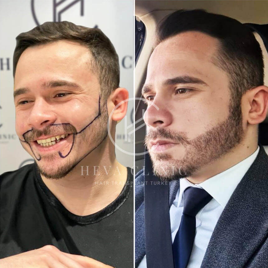 przeszczep brody męskiej przed i po klinice heva