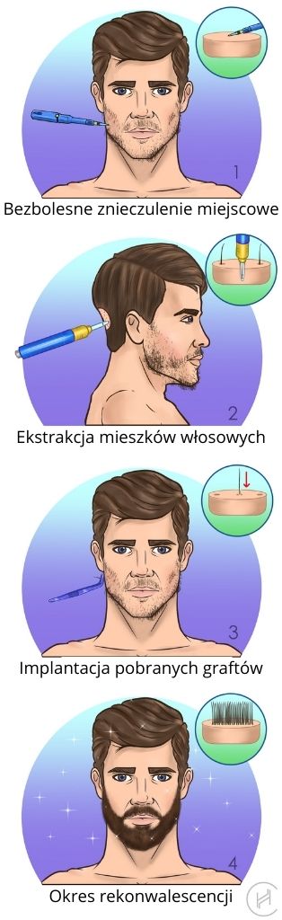 Przeszczep brody Przeszczep brody