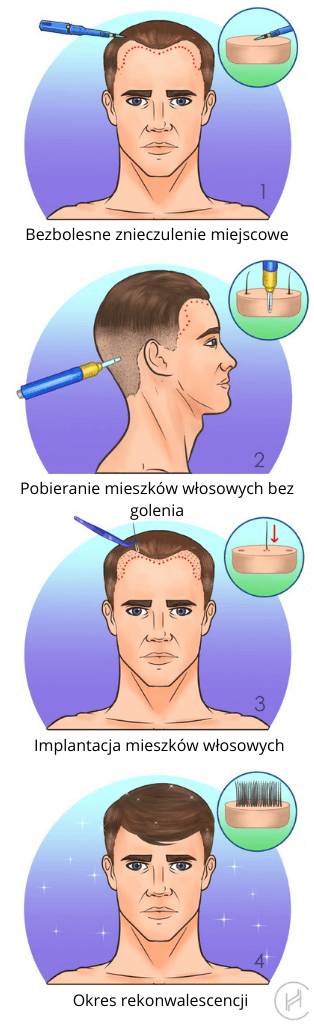 Technika przeszczepu włosów bez golenia