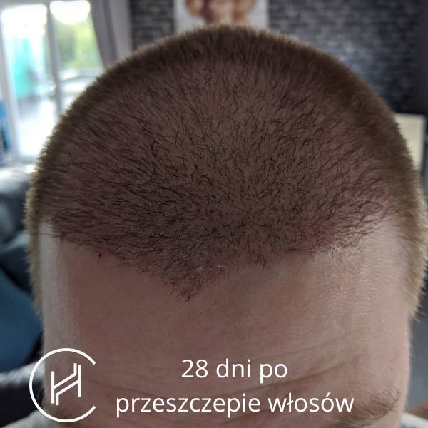 28 dni po zabiegu przeszczepu włosów zdjęcie