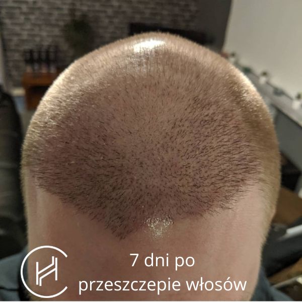 7 dni po operacji przeszczepu włosów zdjęcie