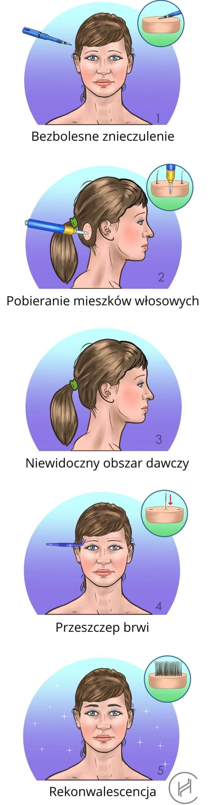 Przeszczep brwi