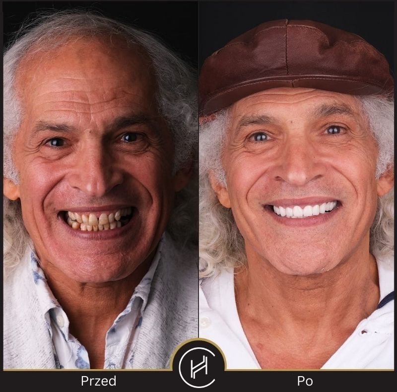 Hollywood Smile w Turcji przed i po efekt