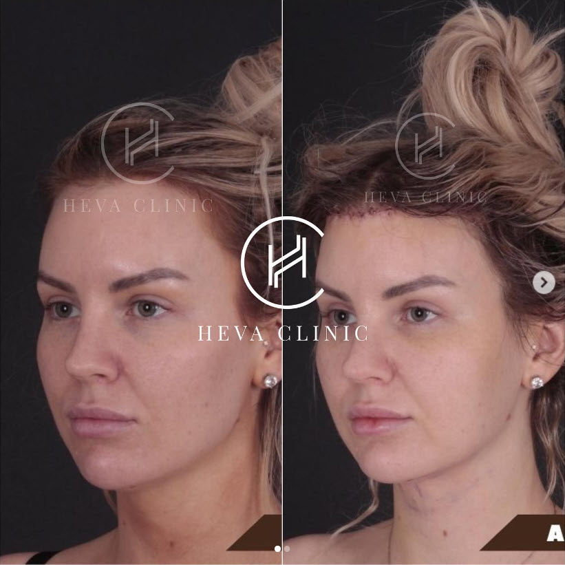 Obniżenie linii włosów-czoła blond kobieta przed i po w klinice heva w Stambule