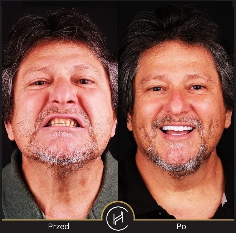 przed i po Hollywood Smile - Heva Clinic