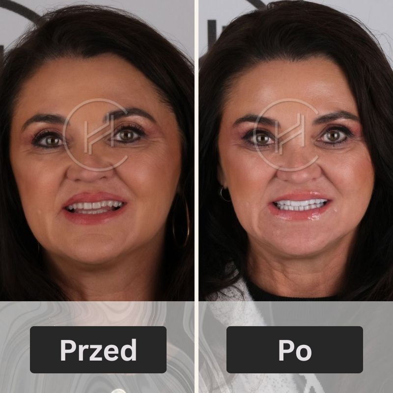 Hollywood Smile w Turcji Kobieta pacjentka przed i po zdjęciu
